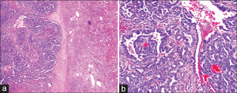 Photomicrograph of final histopathology from right partial nephrectomy 6 years before fine-needle aspiration. (a) Low power view of the epithelial and stromal components with adjacent uninvolved renal parenchyma (H and E, ×50). (b) High power view of predominately the epithelial component (H and E, ×200)