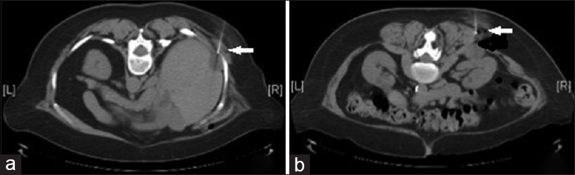 Computed tomography images (a) showing 2.8 cm perihepatic cystic mass, indicated by the arrow (b) showing 3.5 cm cystic mass in the right renal fossa, indicated by the arrow