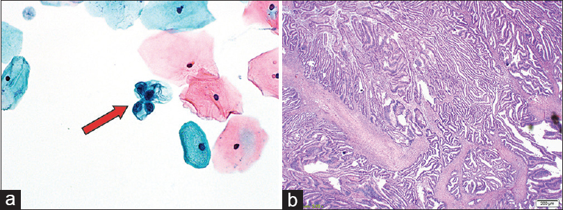 Histologic results in a 47-year-old female. (a) Liquid-based Papanicolaou test with a rare cluster of benign endometrial cells (arrow) (×20). (b) Hysterectomy specimen with International Federation of Gynecology and Obstetrics Grade I endometrial adenocarcinoma arising in a background of atypical complex hyperplasia (H and E, ×10)