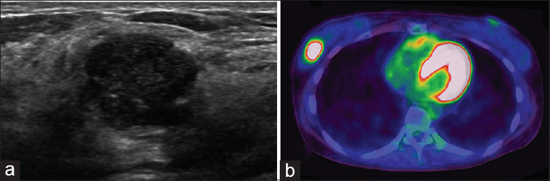 Ultrasonographic and radiographic findings. (a) A relatively well-demarcated, lobulated, hypoechoic mass with mild heterogeneous echogenicity is noted, showing a focal, ill-defined border, suggesting the possibility of malignancy. (b) Positron emission tomography-computed tomography revealing focal fluorodeoxyglucose uptake in the same lesion