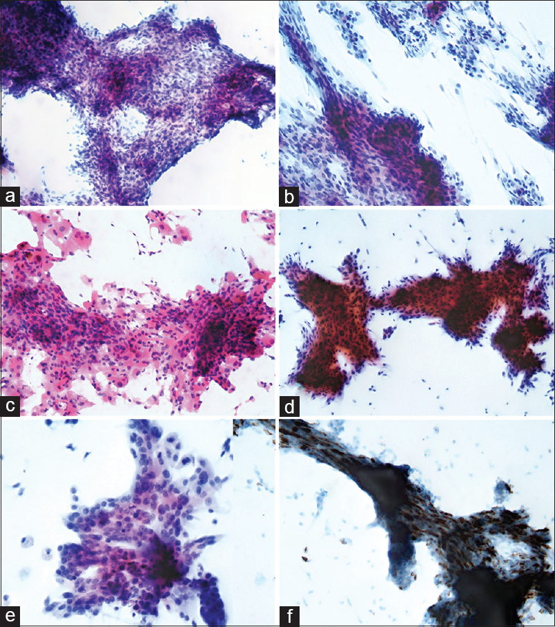 Cytologic findings. (a) Conventional smear reveals many chunky clusters of hyperchromatic spindle cells with fascicular arrangement (Pap, ×200). (b) The spindle cells have angulated nuclei (×400). (c) Some polygonal-to-epithelioid cells are irregularly aggregated (H and E, ×400). (d) Liquid-based preparation reveals an apparent feathery appearance in the periphery with hyperchromatic atypical nuclei (Pap, ×200). (e) Some epithelioid cells forming pseudoglandular structure, reminiscent of cribriform ductal carcinoma in situ are noted (Pap, ×1K). (f) Immunohistochemical staining for CD56 using the liquid-based preparation shows strong positivity (×1K)