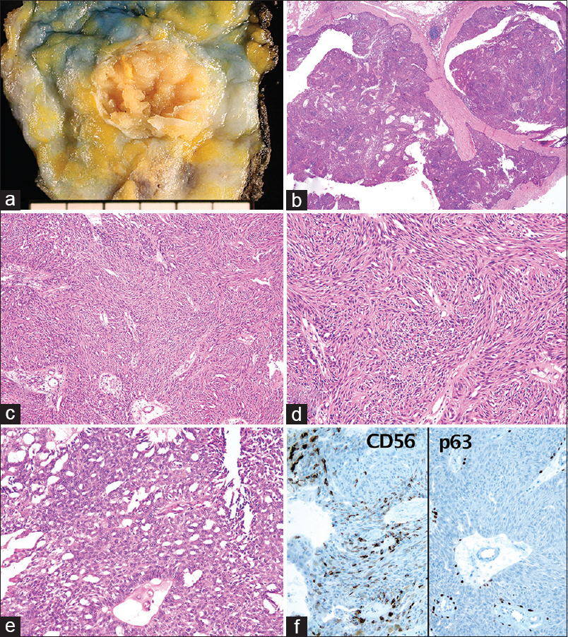 Gross and microscopic findings. (a) A well-demarcated, multinodular, yellow-white solid mass surrounded by a thin fibrous capsule. (b) Microscopically, it is an intraductal hypercellular mass (H and E, ×15). (c) Monotonous proliferation of ductal cells showing a striking spindle appearance (×100). (d) Mostly, the tumor cells show a conspicuous whorling, fascicular, and streaming arrangement (×400). (e) Focal area shows an apparent cribriform pattern (×400). (f) Immunohistochemical staining for CD56 is positive and that for p63 reveals partial loss of myoepithelial cells (×400)