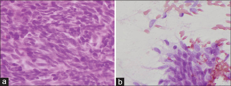 (a) Monotonous oval to spindle shaped nuclei with fine granular chromatin, inconspicuous nucleoli and scant cytoplasm (H and E, ×400). (b) The scattered cells similar to clustered tumor cells (H and E, ×400)