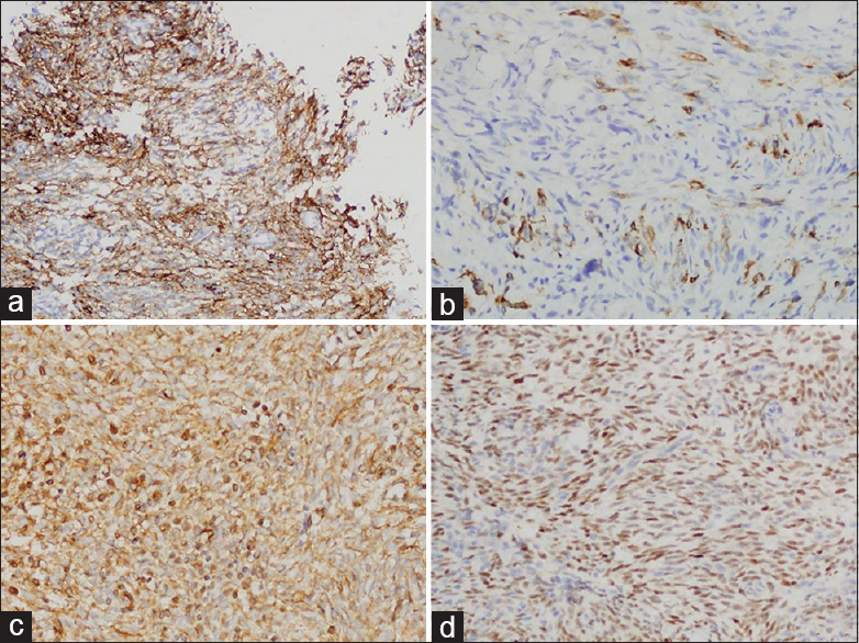 Immunohistochemical expression of EMA (a), CK (b), vimentin (c), and transduction-like enhancing protein 1 (d) in tumor cells