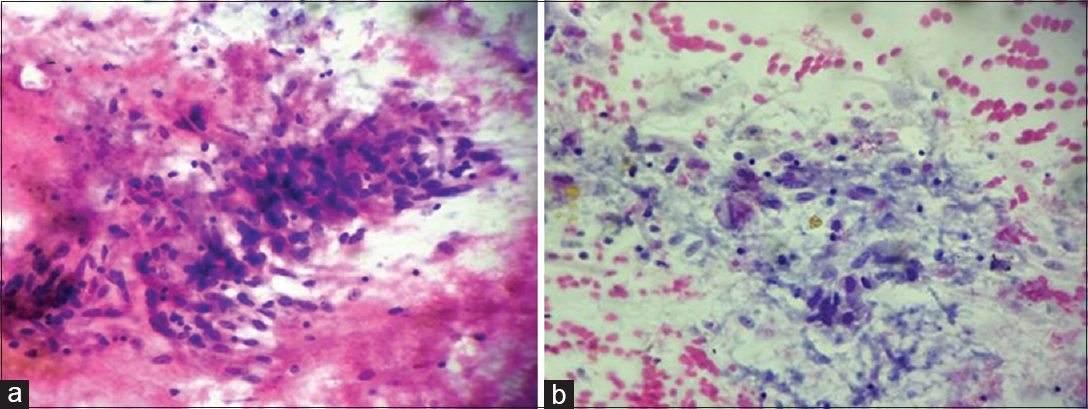 (a) Smears showed epithelioid cell granuloma in a necrotic background (May-Grünwald-Giemsa, ×400). (b) Smears showed epithelioid cell collection (Papanicolaou, ×400)