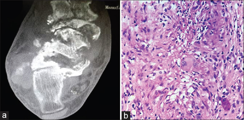 (a) Computed tomography scan showed multiple irregular lytic foci involving the talar, navicular, part of calcaneum, and lateral cuneiform with surrounding edema with coke-like sequestrum. (b) Trucut biopsy showed epithelioid cell granulomas along with Langhan's giant cells (H and E, ×400)