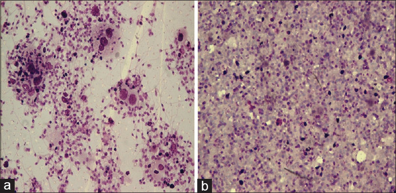 (a) Few cystic macrophages engulfing spermatozoa, numerous spermatids in a clear background (MGG, ×400). (b) Numerous spermatozoa, spermatids in a proteinaceous background with no inflammation (MGG, ×400)