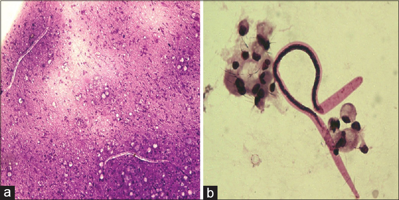 (a) Microfilaria in an acute inflammatory background (MGG, ×400). (b) Microfilaria with background showing few histiocytes (MGG, ×400)