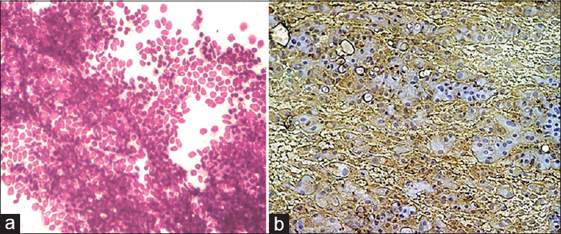 (a) The cytospin smears were cellular with the presence of monolayer sheets; cells were round to oval with vesicular nuclei, small inconspicuous nucleoli along with stromal fragments (MGG, ×400). (b) Tumor cells showed immunoreactivity with calretinin (IHC, ×400)