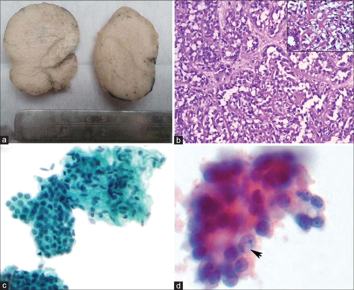 (a) Well-circumscribed mass with gray-white homogenous appearance, (b) tubular variant of adenomyoepithelioma - dark staining cuboidal epithelial cells and outer prominent myoepithelial cells with clear cytoplasm (H and E, ×100) (inset – higher magnification shows bland nature of both epithelial and myoepithelial cells (H and E, ×200), (c) Fine-needle aspiration cytology smear with bland round epithelial cells closely admixed with abundant oval-spindled myoepithelial cells. No atypia is present (Pap stain, ×400) (d) Intranuclear inclusion (arrow) in few myoepithelial cells (Pap oil immersion)