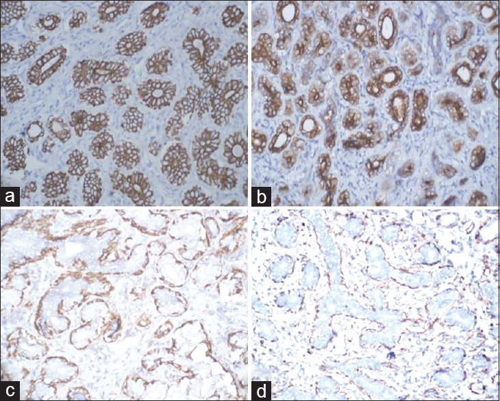 (a) Cytokeratin positivity of ductal epithelial cells (cytokeratin, ×100), (b) epithelial membrane antigen positive epithelial cells (EMA, ×100), (c) Calponin positivity in myoepithelial cells (Calponin, ×100), (d) p63 positive staining in myoepithelial cells (p63, ×100)