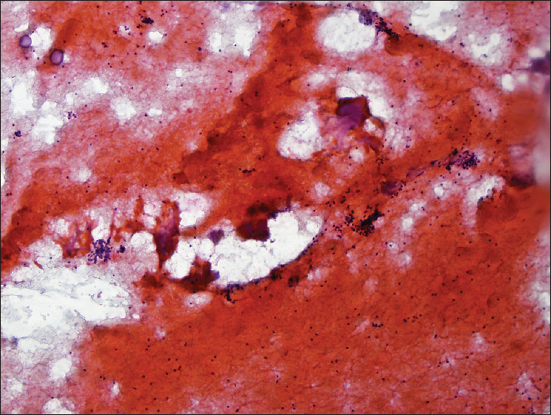 The thyroid fine-needle aspiration shows a background of colloid, bland follicular cells, and a few multinucleated giant cells