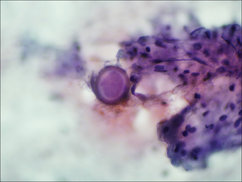 Some of the mature large spherules having the “pink ball” appearance on Pap-stained smears containing endospores