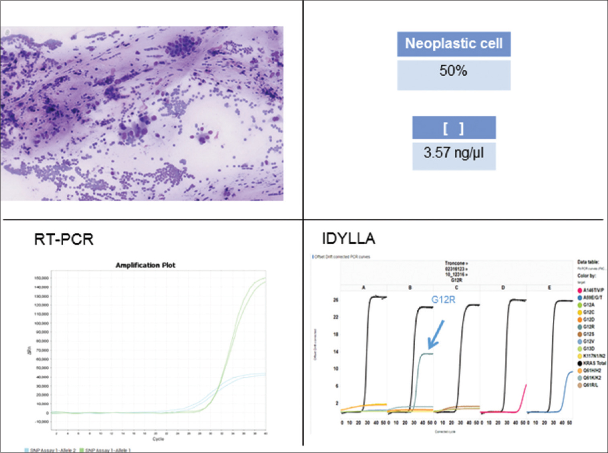 Example of concordant molecular results in a KRAS exon 2 mutated sample (case #8, Table 1). Archival DNA was extracted from a Diff-Quik-stained smear of pancreatic cancer featuring 50% of neoplastic cells and a concentration of 3, 57 ng/μl. Representative graphs of standard real-time polymerase chain reaction and Idylla are reported both showing G12R KRAS mutation