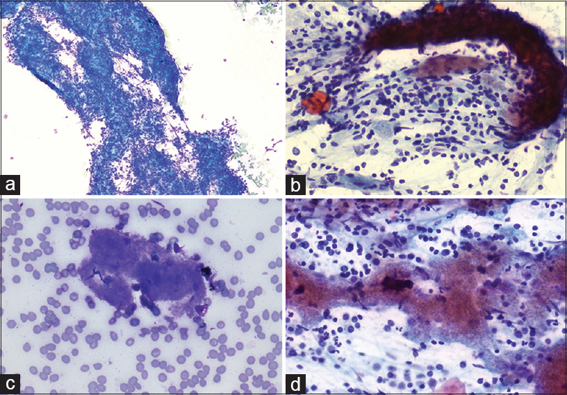 Endoscopic ultrasound-guided fine-needle aspiration of pancreatic tail lesion. (a) Diff-Quik air-dried smear preparation (×10) shows many lymphocytes tangles with crushing artifact. (b) Loose aggregates of bland spindle cells (Rapid Papanicolaou, ×40). (c) Diff-Quik air-dried smear preparation (×40) highlights Blue fluffy, acellular, “cotton candy” materials. (d) Aggregates of the same fluffy materials (Rapid Papanicolaou, ×40)