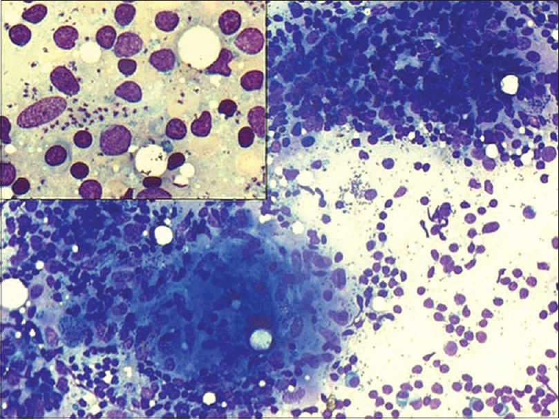 Lymph node aspirate with scattered epithelioid cell granuloma (Giemsa, ×20). Inset: Numerous intracellular as well as extracellular Leishman–Donovan bodies (Giemsa, ×40)