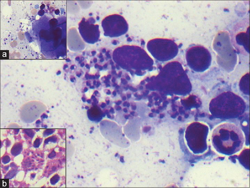 Bone marrow aspirate: Histiocytes showing numerous intracellular Leishman–Donovan bodies. Scattered extracellular Leishman–Donovan bodies (Giemsa, ×100); Inset: (a) Megakaryocyte surrounded with Leishman–Donovan bodies (Giemsa ×20) (b) Bone marrow biopsy showing histiocytes containing Leishman–Donovan bodies (H and E, ×40)