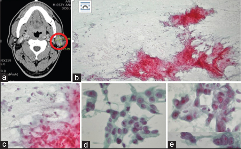 (a) A neck computed tomography showing a bilobular heterogeneous mass (red circle) in the left parotid gland with progressive enhancement, most probably a pleomorphic adenoma. (b) Aspiration cytology showing moderate cellularity with chondromyxoid matrix (Pap, ×100). (c) The periphery of the myxoid stroma includes attached bland-looking ovoid epithelial cells (Pap, ×200). (d) Some clusters of the epithelial cells containing more plump epithelial cells with abundant oncocytic cytoplasm (Pap, ×400). (e) Other clusters of the epithelial cells exhibiting more severe cytologic atypia; a higher nuclear-/cytoplasmic ratio, hyperchromatic nuclei, irregular nuclear membrane, prominent nucleoli, and abundant vacuolated cytoplasm (Pap, ×400)