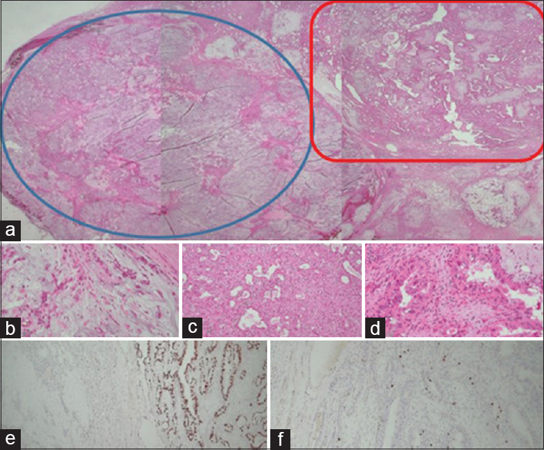 (a) The histology of the tumor showing two different nodules; myxoid hypocellular in one (blue circle) and another cellular mass with scanty myxoid stroma (red rectangle) (H and E, ×10). (b) This section showing a part of the chondromyxoid stroma and attenuated epithelial component (H and E, ×40). (c) This portion showing cellular proliferation composed of abundant eosinophilic epithelial cells with oncocytic changes (H and E, ×40). (d) The epithelial cells reveal distinct cytologic atypia with enlarged hyperchromatic nuclei and moderate pleomorphism (H and E, ×40). (e) p53 immunohistochemical staining showing different expressions between the two parts: very low expression in the chondromyxoid nodule and high expression in the atypical portion (p53, ×40). (f). The Ki-67 proliferation index is also significantly higher in the atypical portion (Ki-67, ×40)