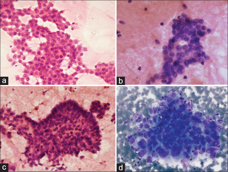 Tumor pattern: Epidermal growth factor receptor mutation positive cases showing flat monolayered sheets (a), acini (b), and papillary fragment of tumor cells (c) (H and E, ×400); (d) A solid overlapping cluster in epidermal growth factor receptor mutation negative case (MGG, ×400)