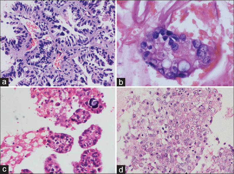 Cellblock sections: epidermal growth factor receptor mutation positive cases tall columnar tumor cells with intervening stroma (a), glandular pattern (b), and papillary fragments (c); (d) a solid sheet-like pattern in epidermal growth factor receptor mutation negative case (H and E, ×400)