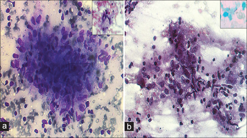 (a) Fine-needle aspiration findings: Epithelioid cell granuloma (Giemsa, ×400). Multinucleate Langhans' type giant cell (Inset; PAP, ×400). (b)Fine-needle aspiration findings: Lymphohistiocytic cell aggregates (PAP, ×400). Acid-fast bacilli (Inset; ×1000)