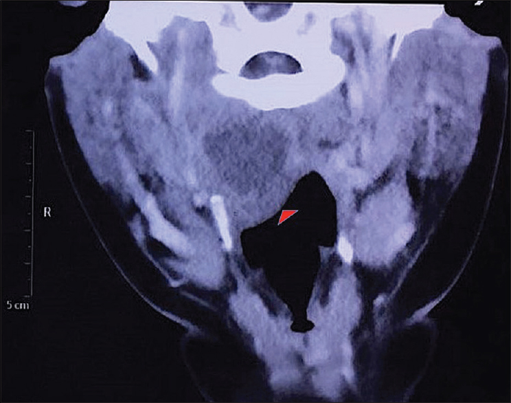 Contrast-enhanced computed tomography neck scan (axial view): Oblong hypodense lesion in the right paramedian retropharyngeal space (arrow) causing attenuation of oropharyngeal air space