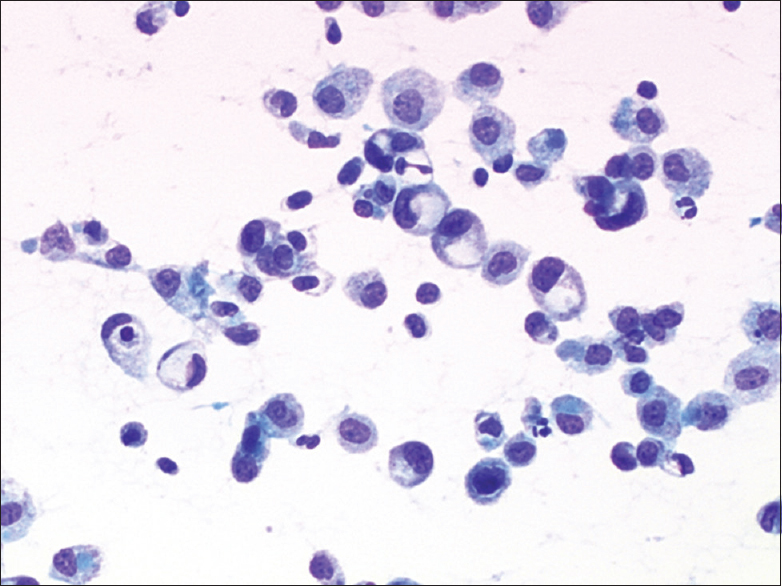 Cytologic features of epithelioid hemangioendothelioma in effusion. Case 2. Loosely cohesive and single plasmacytoid tumor cells exhibited more nuclear atypia and had a higher nuclear/cytoplasmic ratio than reactive mesothelial cells did (direct smear, Papanicolaou stain, ×400)