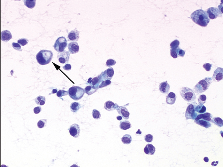 Cytologic features of epithelioid hemangioendothelioma in effusion. Case 2. The nuclei were eccentrically located, and these cells resembled plasmacytoid or signet ring cells. Few cells exhibited an intracytoplasmic lumina (arrow; direct smear, Papanicolaou stain, ×400)