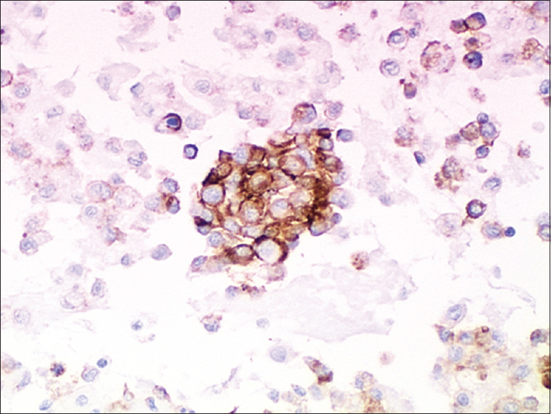 Immunohistologic findings. Case 2. Tumor cells were CD31-positive (strong, diffuse) (cell blocks, ×200)