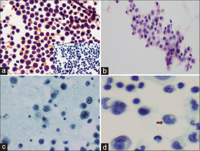 (a) Medium to large-sized lymphoid cells with nucleoli and brisk mitosis. Pap, ×200. Inset: Karyorrhexis, Pap, ×200. (b) Cell block showing small lymphoid cells with cleaved nuclei; admixed other cells seen. H and E, ×200. (c) Atypical plasmacytoid cells, binucleate cells, and mitosis. Pap, ×200. (d) Intermediate to large-sized “flower” cells (red arrow), Pap, ×400