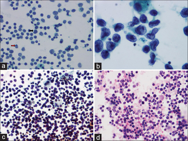 (a) Intermediate-sized lymphoid cells with delicate nuclear membrane, nuclear nicks (black arrow), and “hand mirror” cells (red arrow). Pap, ×200. (b) Very large cells, with a kidney-shaped, folded nucleus, fine chromatin, and single nucleolus. Pap, ×400. (c) Thick lymphocyte-rich smear, Pap, ×100. (d) Cellblock of a case of lymphocyte-rich effusion showing a polymorphous population of cells, H and E, ×200