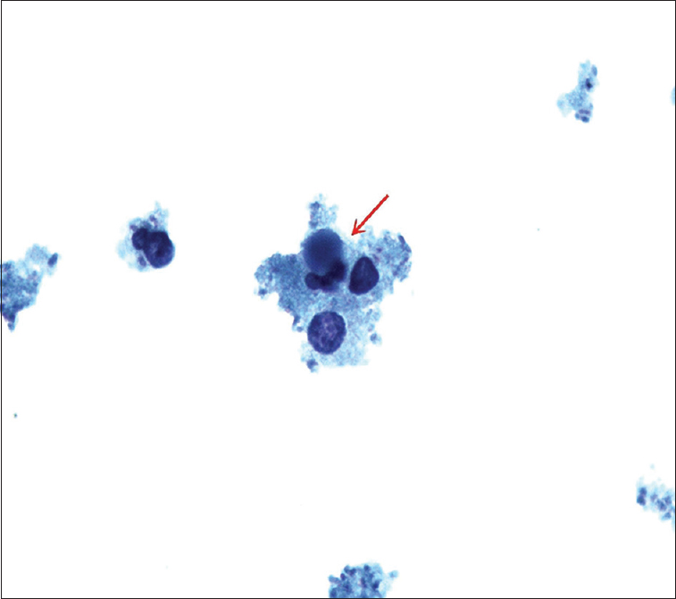 ThinPrep slide of pleural fluid showing three-lobed neutrophil containing intracytoplasmic round basophilic homogeneous body with smooth borders forming lupus erythematosus cell (red arrow) (Papanicolaou stain, ×100)