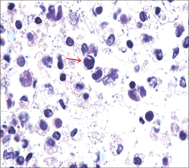 Tart cell. Cell block showing round bodies within the macrophage pushing the nucleus to periphery forming tart cell (red arrow). These homogeneous bodies can be seen in clusters forming conglomerates along with many bacteria in the background (H and E, ×100)