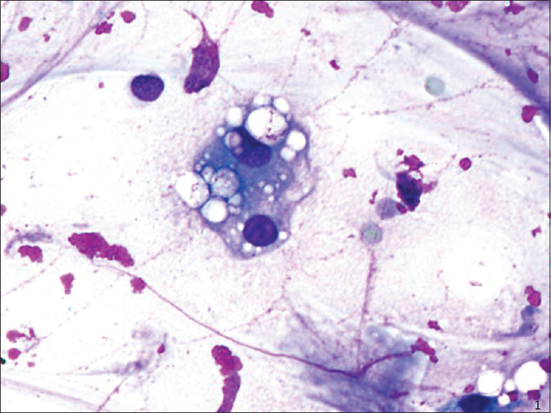 Fine-needle aspiration (smear, Diff-Quik stain): Multivacuolation in bi-nucleate cell and extracellularly