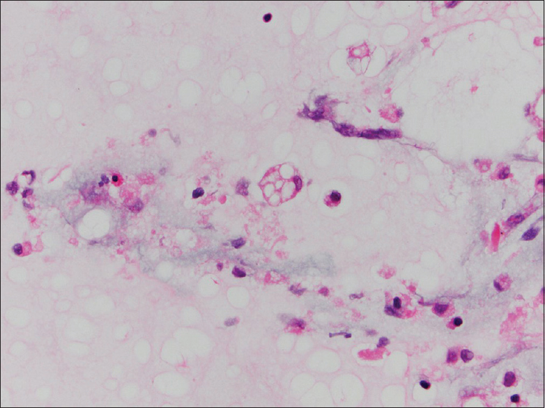 Bronchoalveolar lavage (cell block, H and E stain): Multivacuolated cell with soap-bubble like cytoplasm representing ghosts of lipid vacuoles