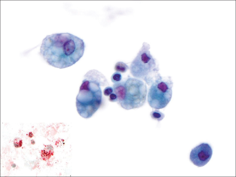 Bronchoalveolar lavage (ThinPrep, Papanicolaou stain): Multiple cells with large vacuoles containing lipid characteristic of exogenous lipoid pneumonia (center) and uninvolved smaller macrophage with finely vacuolated/granular cytoplasm (bottom right). Oil Red O stain bronchoalveolar lavage (cytospin, Oil Red O stain) inset: Lipid containing cells have abundant droplets including large and small