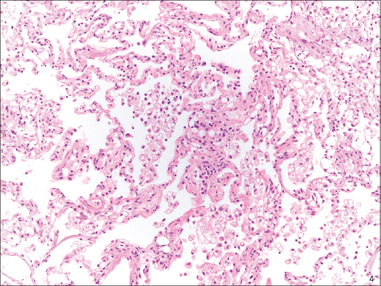 Transbronchial biopsy (H and E stain): Exogenous lipoid pneumonia, low magnification