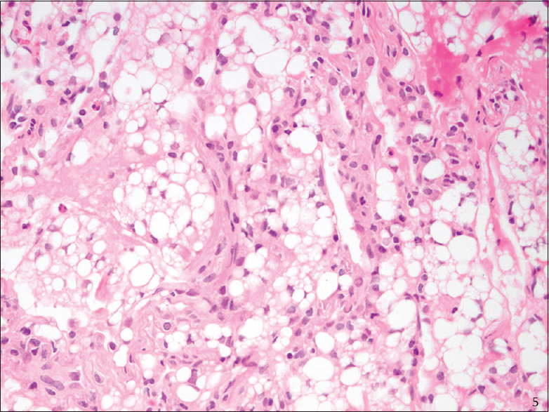 Transbronchial biopsy (H and E stain): Exogenous lipoid pneumonia, high magnification