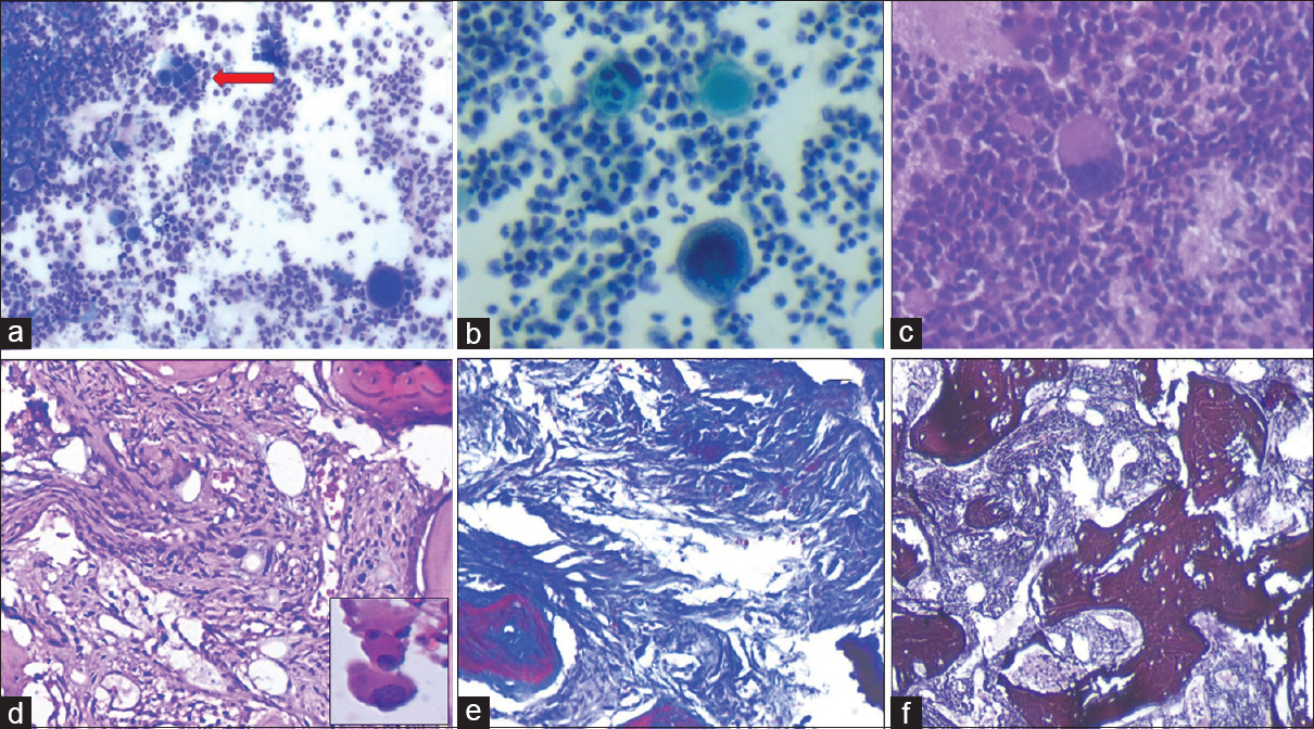 (a) Cellular smear showing numerous myeloid cells in various stages of maturation, occasional group of erythroid cells (red arrow), and scattered megakaryocytes (Giemsa, ×200). (b) Large multinucleated and multilobulated megakaryocytes (Pap, ×400). (c) Cell block section revealing scattered megakaryocytes along with numerous myeloid series cells (H and E, ×200). (d) Bone marrow biopsy shows markedly hypocellular marrow with diffuse fibrosis of marrow spaces (H and E, ×200). Inset shows megakaryocytes. (e) Fibrotic areas show increase in reticulin with extensive intersection (reticulin, ×200). (f) Masson's trichrome stain showing diffuse blue-stained coarse bundles of collagen (MT, ×200)