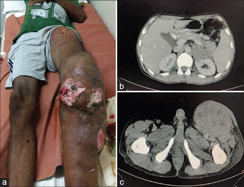 (a) Left leg with multiple subcutaneous swellings and few ulcerated nodules. (b) Axial computed tomography: Homogeneously enhancing relatively hypodense left suprarenal mass with loss of fat plane in anterior pararenal space. (c) Axial computed tomography: Heterogeneously enhancing left inguinal lymph nodal mass