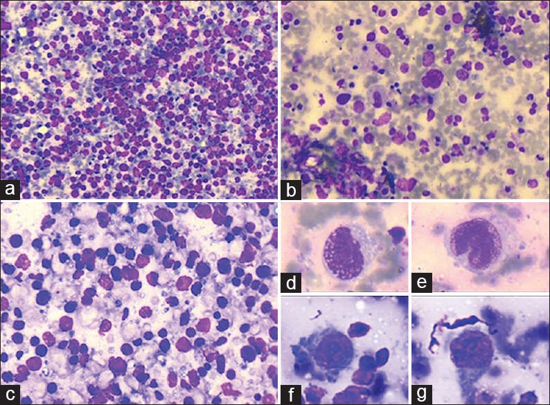 (a) Cellular aspirates comprising dispersed population of intermediate to large lymphocytes (Giemsa, ×100). (b) Polymorphous background with scattered histiocytes (Giemsa, ×200). (c) Dispersed moderately pleomorphic atypical lymphoid cells (Giemsa, ×400). (d-g) Atypical large lymphoid cells with high-grade nuclear atypia; high nucleus-cytoplasm ratio, nuclear membrane irregularity, opened up chromatin, and prominent nucleoli (Giemsa, ×400)