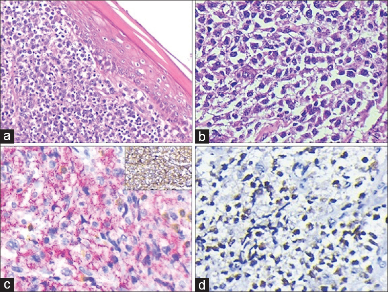 (a) Tumor cells localized in the dermis (H and E, ×200). (b) Sheet and cords of atypical lymphoid cells displaying nuclear atypia (H and E, ×400). (c) CD20 positive tumor cells (Vulcan Fast Red Chromogen). Few scattered CD3 positive lymphocytes also seen. Inset: Leukocyte common antigen diffuse surface expression (DAB chromogen) (IHC, ×400). (d) Positive nuclear staining for Bcl-6 (IHC, ×400)