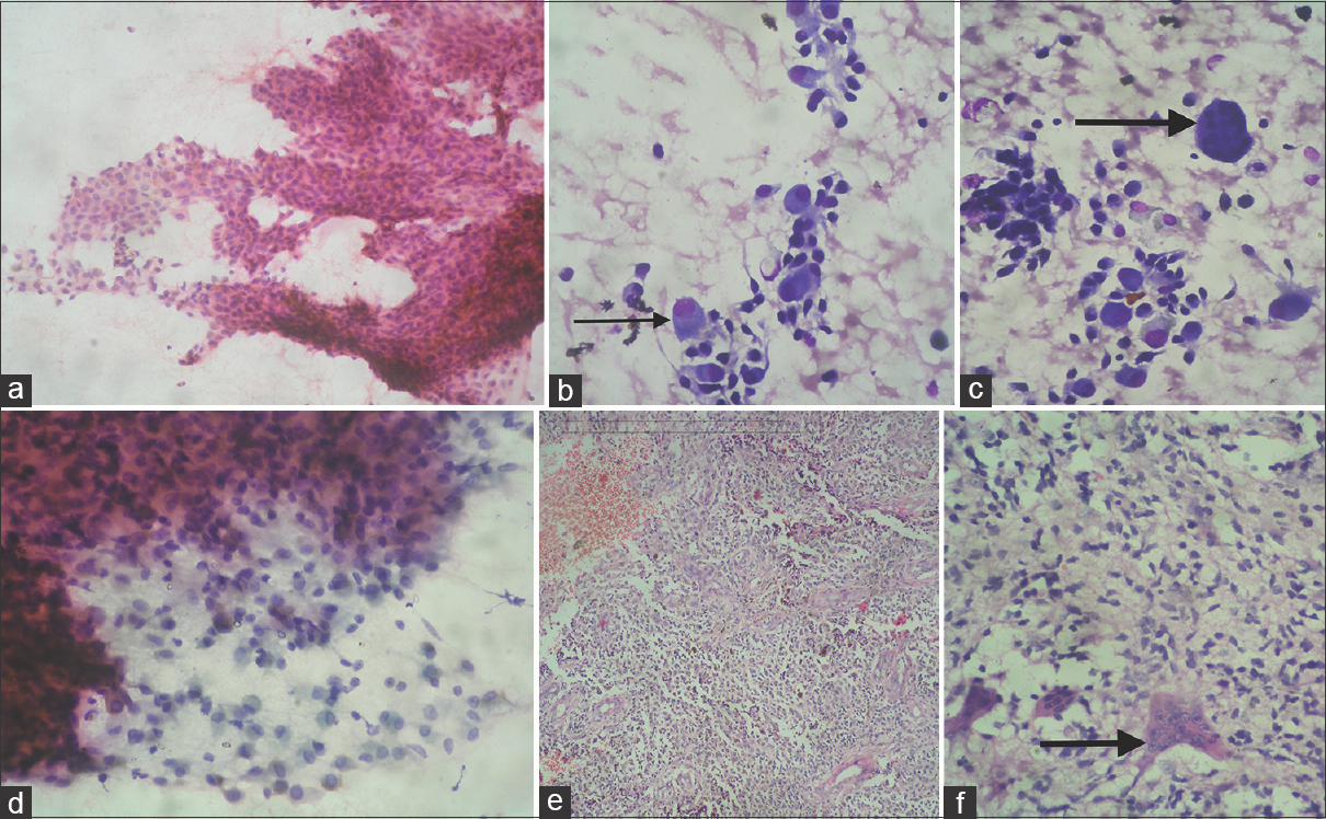 (a-d) Fine-needle aspiration cytology of the swelling showed cellular tumor with osteoblasts (thin arrow), scattered giant cells (thick arrow), and spindle cells entangled in myxoid matrix (May-Grunwald-Giemsa, ×40; H and E, ×40). (e and f) Histopathological examination showed cellular osteoblastic tumor with ectatic blood vessels and scattered giant cells (thick arrow) (H and E, ×40)