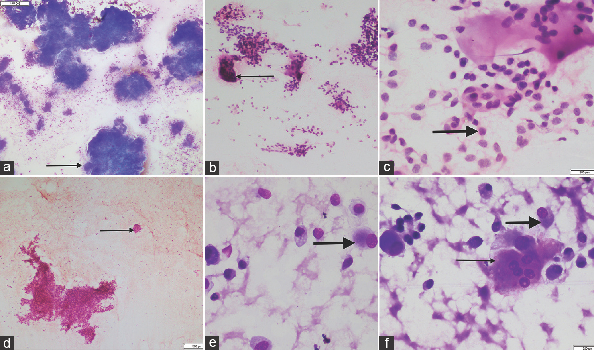 (a-c) Fine-needle aspiration cytology of giant-cell tumor showed spindle cell clusters and numerous osteoclasts arranged at the periphery of the clusters with checkerboard pattern (thin arrow). The mononuclear round cells show central uniform nuclei (thick arrow) (May-Grunwald-Giemsa, ×4; H and E, ×10 and ×40) (This figure of giant-cell tumor is original and is from another case. It is shown for comparison with osteoblastoma and has no relation with present case). (d-f) In contrast, fine-needle aspiration cytology of osteoblastoma showed few scattered osteoclastic giant cells (thin arrow) with fair number of osteoblasts having perinuclear hof (thick arrow) (May-Grunwald-Giemsa, ×40; H and E, ×4)