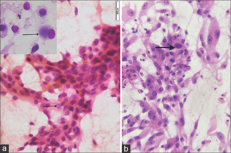 (a) Fine-needle aspiration cytology of osteoblastoma showed osteoblasts with perinuclear hof (inset) and cells showing uniform fine chromatin with inconspicuous nucleoli (thin arrow). Atypical mitosis is not seen (May-Grunwald-Giemsa, ×40; H and E, ×40). (b) Fine-needle aspiration cytology of osteosarcoma showed cellular smears comprising round-to-spindle cells with moderate-to-severe pleomorphism and nucleus with coarse chromatin and prominent nucleoli (thick arrow). Mitotic figures are present (H and E, ×40) (This figure of osteosarcoma is original and is from another case. It is shown for comparison with osteoblastoma and has no relation with the present case)