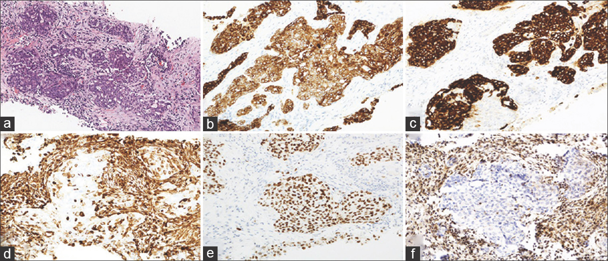 (a) Nests of malignant cells in a background of desmoplastic stroma and acute and chronic inflammation (H and E, ×200). (b) CK7 demonstrates diffuse cytoplasmic staining (×400). (c) CK20 demonstrates strong cytoplasmic staining (×400). (d) Vimentin demonstrates patchy positive staining in malignant cells (×400). (e) PAX8 demonstrates diffuse nuclear staining (×400). (f) INI-1 demonstrates loss of nuclear staining (×400)