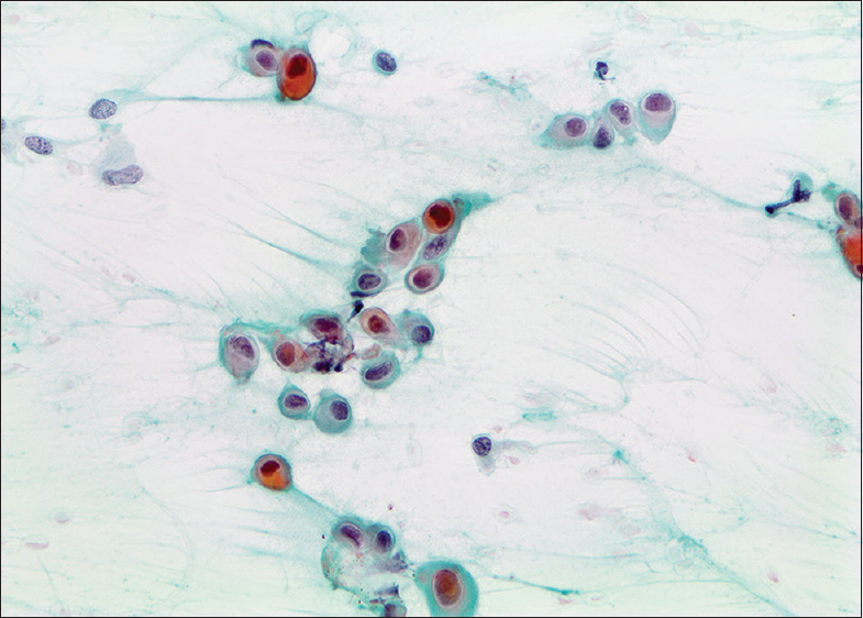 Papanicolaou-stained smears showing atypical epithelioid cells with abundant dense cytoplasm and orangeophilia