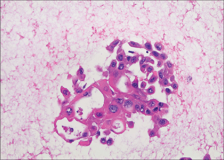 Cell block showing cohesive cells with squamous features and atypical nuclei