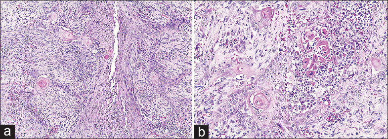 (a) Low power H and E of resection specimen showing component of tumor with squamous features including infiltrating tumor cells in sheets with keratin pearls. (b) High power H and E of resection specimen showing tumor with squamous features including sheet-like architecture, abundant eosinophilic cytoplasm, keratin pearls, and dyskeratotic cells